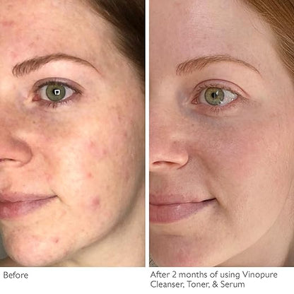 Vinopure Skin Perfecting Serum